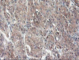 ALS2CR1 / NIF3L1 Antibody - IHC of paraffin-embedded Carcinoma of Human liver tissue using anti-NIF3L1 mouse monoclonal antibody.