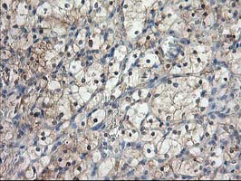 ALS2CR1 / NIF3L1 Antibody - IHC of paraffin-embedded Carcinoma of Human kidney tissue using anti-NIF3L1 mouse monoclonal antibody. (Heat-induced epitope retrieval by 10mM citric buffer, pH6.0, 100C for 10min).