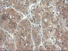 ALS2CR1 / NIF3L1 Antibody - IHC of paraffin-embedded Carcinoma of Human liver tissue using anti-NIF3L1 mouse monoclonal antibody. (Heat-induced epitope retrieval by 10mM citric buffer, pH6.0, 100C for 10min).