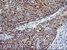 ALS2CR1 / NIF3L1 Antibody - IHC of paraffin-embedded Adenocarcinoma of Human ovary tissue using anti-NIF3L1 mouse monoclonal antibody. (Heat-induced epitope retrieval by 10mM citric buffer, pH6.0, 100C for 10min).