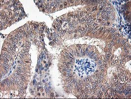 ALS2CR1 / NIF3L1 Antibody - IHC of paraffin-embedded Adenocarcinoma of Human endometrium tissue using anti-NIF3L1 mouse monoclonal antibody. (Heat-induced epitope retrieval by 10mM citric buffer, pH6.0, 100C for 10min).