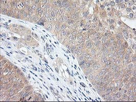 ALS2CR1 / NIF3L1 Antibody - IHC of paraffin-embedded Carcinoma of Human bladder tissue using anti-NIF3L1 mouse monoclonal antibody. (Heat-induced epitope retrieval by 10mM citric buffer, pH6.0, 100C for 10min).
