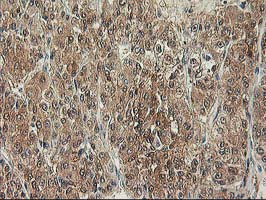 ALS2CR1 / NIF3L1 Antibody - IHC of paraffin-embedded Carcinoma of Human liver tissue using anti-NIF3L1 mouse monoclonal antibody.