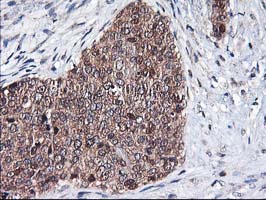 ALS2CR1 / NIF3L1 Antibody - IHC of paraffin-embedded Adenocarcinoma of Human breast tissue using anti-NIF3L1 mouse monoclonal antibody.