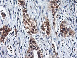 ALS2CR1 / NIF3L1 Antibody - IHC of paraffin-embedded Carcinoma of Human lung tissue using anti-NIF3L1 mouse monoclonal antibody.