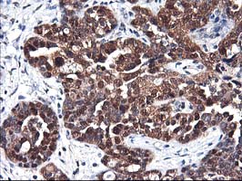 ALS2CR1 / NIF3L1 Antibody - IHC of paraffin-embedded Adenocarcinoma of Human ovary tissue using anti-NIF3L1 mouse monoclonal antibody.