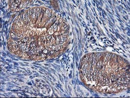 ALS2CR1 / NIF3L1 Antibody - IHC of paraffin-embedded Adenocarcinoma of Human endometrium tissue using anti-NIF3L1 mouse monoclonal antibody.
