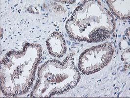 ALS2CR1 / NIF3L1 Antibody - IHC of paraffin-embedded Carcinoma of Human prostate tissue using anti-NIF3L1 mouse monoclonal antibody.