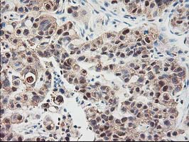 ALS2CR1 / NIF3L1 Antibody - IHC of paraffin-embedded Carcinoma of Human lung tissue using anti-NIF3L1 mouse monoclonal antibody.