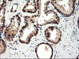 ALS2CR1 / NIF3L1 Antibody - IHC of paraffin-embedded Carcinoma of Human prostate tissue using anti-NIF3L1 mouse monoclonal antibody.