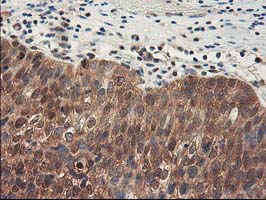 ALS2CR1 / NIF3L1 Antibody - IHC of paraffin-embedded Carcinoma of Human bladder tissue using anti-NIF3L1 mouse monoclonal antibody.