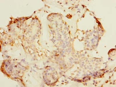 ALS2CR1 / NIF3L1 Antibody - Immunohistochemistry of paraffin-embedded human breast cancer using antibody at dilution of 1:100.
