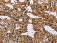 ALS2CR1 / NIF3L1 Antibody - Immunohistochemistry of paraffin-embedded Human liver cancer using NIF3L1 Polyclonal Antibody at dilution of 1:30.