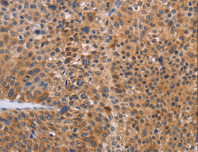 ALS2CR1 / NIF3L1 Antibody - Immunohistochemistry of paraffin-embedded Human liver cancer using NIF3L1 Polyclonal Antibody at dilution of 1:30.