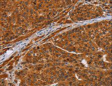 ALS2CR1 / NIF3L1 Antibody - Immunohistochemistry of paraffin-embedded Human liver cancer using NIF3L1 Polyclonal Antibody at dilution of 1:20.
