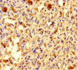 ALS2CR11 Antibody - Immunohistochemistry of paraffin-embedded human melanoma using ALS2CR11 Antibody at dilution of 1:100
