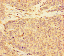 ALS2CR11 Antibody - Immunohistochemistry of paraffin-embedded human ovarian cancer using ALS2CR11 Antibody at dilution of 1:100