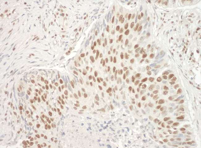 ALY / THOC4 Antibody - Detection of Human Aly by Immunohistochemistry. Sample: FFPE section of human non-small cell lung cancer. Antibody: Affinity purified rabbit anti-Aly used at a dilution of 1:1000 (1 Detection: DAB.