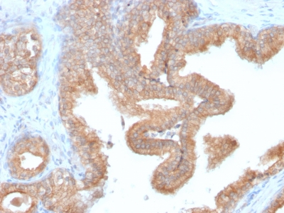 AMACR / P504S Antibody - Formalin-fixed, paraffin-embedded human Prostate Carcinoma stained with AMACR Recombinant Rabbit Monoclonal Antibody (AMACR/2748R).