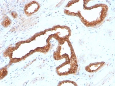 AMACR / P504S Antibody - Formalin-fixed, paraffin-embedded human Renal Cell Carcinoma stained with AMACR Recombinant Rabbit Monoclonal Antibody (AMACR/2748R).