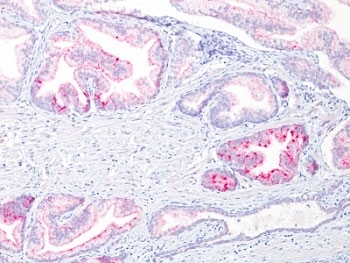 AMACR / P504S Antibody - Formalin-fixed, paraffin-embedded human prostate carcinoma stained with AMACR / p504S antibody (13H4)