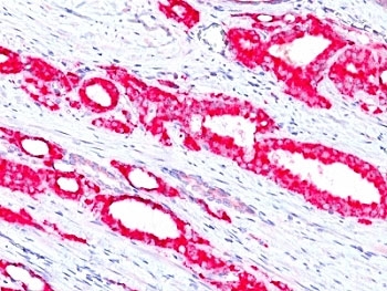 AMACR / P504S Antibody - Formalin-fixed, paraffin-embedded human prostate carcinoma stained with p504S antibody (13H4)