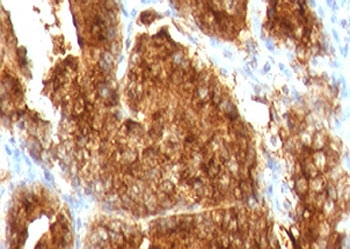 AMACR / P504S Antibody - IHC testing of FFPE human prostate carcinoma with AMACR antibody (clone 2MACR-1). Required HIER: steam section in pH6 citrate buffer for 20 min and allow to cool prior to staining.