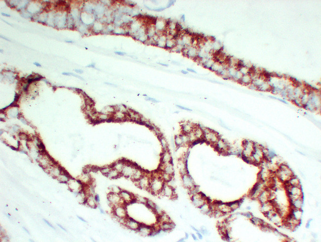AMACR / P504S Antibody - Prostatic Carcinoma 1 High Magnification