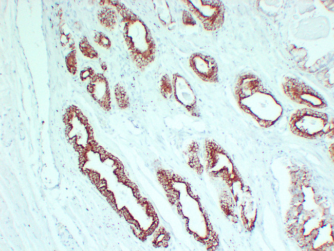 AMACR / P504S Antibody - Prostatic Carcinoma 1