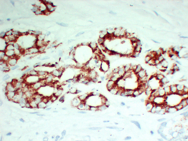 AMACR / P504S Antibody - Prostatic Carcinoma 2 High Magnification