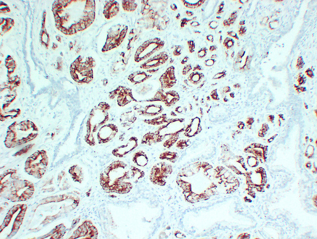 AMACR / P504S Antibody - Prostatic Carcinoma 2