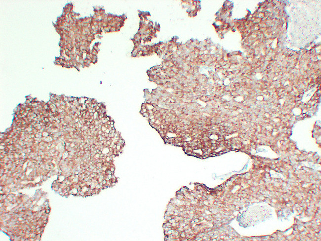 AMACR / P504S Antibody - Prostatic Carcinoma 3