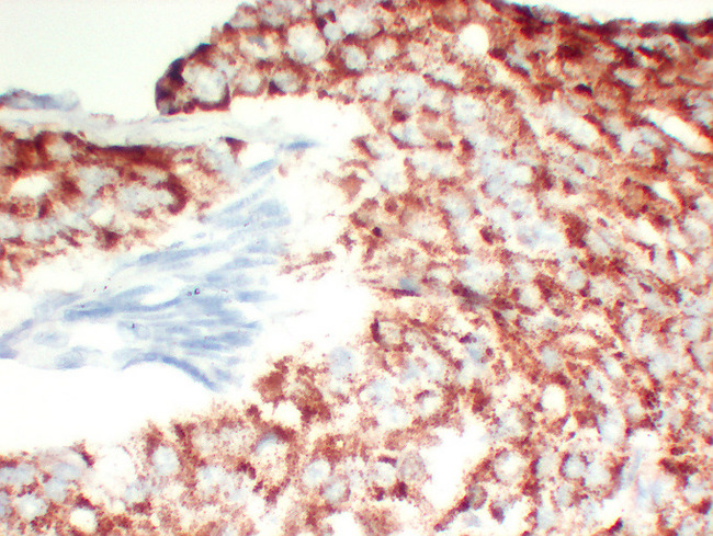 AMACR / P504S Antibody - Rostatic Carcinoma 3 High Magnification