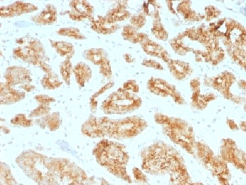 AMACR / P504S Antibody - IHC testing of FFPE human prostate carcinoma with AMACR antibody (clone AMACR/1723). HIER: steam sections in pH6, 10mM citrate buffer for 10-20 min.