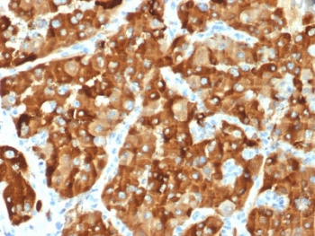 AMACR / P504S Antibody - IHC testing of FFPE human renal carcinoma with AMACR antibody. Required HIER: steam section in pH6 citrate buffer for 20 min and allow to cool prior to staining.