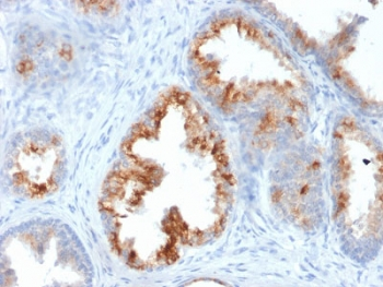 AMACR / P504S Antibody - IHC testing of FFPE human prostate carcinoma with AMACR antibody. Required HIER: steam section in pH6 citrate buffer for 20 min and allow to cool prior to staining.