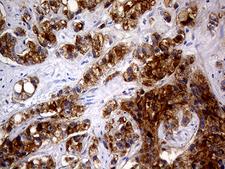 AMACR / P504S Antibody - Immunohistochemical staining of paraffin-embedded Carcinoma of Human prostate tissue using anti-AMACR mouse monoclonal antibody. (Heat-induced epitope retrieval by 1mM EDTA in 10mM Tris buffer. (pH8.0) at 120°C for 3 min. (1:1000)