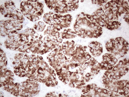 AMACR / P504S Antibody - Immunohistochemical staining of paraffin-embedded Carcinoma of Human liver tissue using anti-AMACR mouse monoclonal antibody. (Heat-induced epitope retrieval by 1mM EDTA in 10mM Tris buffer. (pH8.5) at 120°C for 3 min. (1:150)