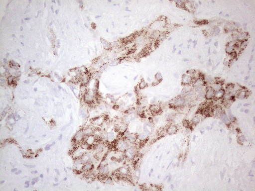 AMACR / P504S Antibody - Immunohistochemical staining of paraffin-embedded Human liver tissue within the normal limits using anti-AMACR mouse monoclonal antibody. (Heat-induced epitope retrieval by 1mM EDTA in 10mM Tris buffer. (pH8.5) at 120°C for 3 min. (1:150)