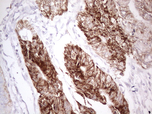 AMACR / P504S Antibody - Immunohistochemical staining of paraffin-embedded Adenocarcinoma of Human colon tissue using anti-AMACR mouse monoclonal antibody. (Heat-induced epitope retrieval by 1mM EDTA in 10mM Tris buffer. (pH8.5) at 120°C for 3 min. (1:150)