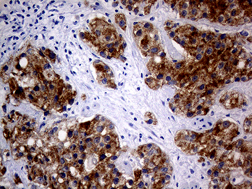 AMACR / P504S Antibody - Immunohistochemical staining of paraffin-embedded Carcinoma of Human prostate tissue using anti-AMACR mouse monoclonal antibody. (Heat-induced epitope retrieval by 1mM EDTA in 10mM Tris buffer. (pH8.0) at 120°C for 3 min. (1:1000)