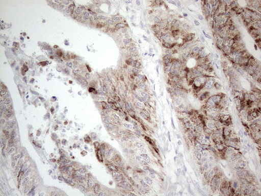 AMACR / P504S Antibody - Immunohistochemical staining of paraffin-embedded Adenocarcinoma of Human colon tissue using anti-AMACR mouse monoclonal antibody. (Heat-induced epitope retrieval by 1mM EDTA in 10mM Tris buffer. (pH8.5) at 120°C for 3 min. (1:150)