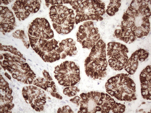 AMACR / P504S Antibody - Immunohistochemical staining of paraffin-embedded Carcinoma of Human liver tissue using anti-AMACR mouse monoclonal antibody. (Heat-induced epitope retrieval by 1mM EDTA in 10mM Tris buffer. (pH8.5) at 120°C for 3 min. (1:150)