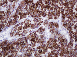 AMACR / P504S Antibody - IHC of paraffin-embedded Carcinoma of Human liver tissue using anti-AMACR mouse monoclonal antibody.