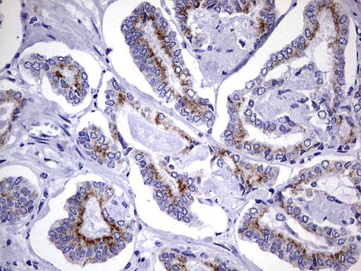 AMACR / P504S Antibody - IHC of paraffin-embedded Human prostate tissue using anti-AMACR mouse monoclonal antibody. (Heat-induced epitope retrieval by 1 mM EDTA in 10mM Tris, pH8.5, 120°C for 3min).