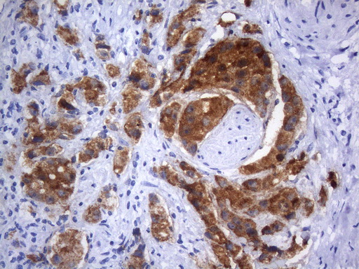 AMACR / P504S Antibody - Immunohistochemical staining of paraffin-embedded carcinoma of human prostate tissue using anti-AMACR mouse monoclonal antibody. HIER pretreatment was done with 1mM EDTA in 10mM Tris buffer. (pH8.0) at 120°C for 2.5 minutes.was diluted 1:2400 and detection was done with HRP secondary and DAB chromogen. Strong cytoplasmic and membraneous stain was seen in >75% ot the tumor cells.