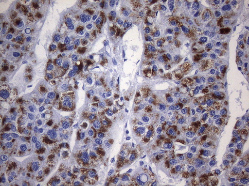 AMACR / P504S Antibody - Immunohistochemical staining of paraffin-embedded carcinoma of human liver tissue using anti-AMACR mouse monoclonal antibody. HIER pretreatment was done with 1mM EDTA in 10mM Tris buffer. (pH8.0) at 120°C for 2.5 minutes.was diluted 1:2400 and detection was done with HRP secondary and DAB chromogen. Strong cytoplasmic and membraneous stain was seen in >50% tumor cells.