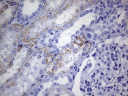 AMACR / P504S Antibody - Immunohistochemical staining of paraffin-embedded human kidney tissue within the normal limits using anti-AMACR mouse monoclonal antibody. HIER pretreatment was done with 1mM EDTA in 10mM Tris buffer. (pH8.0) at 120°C for 2.5 minutes.was diluted 1:800 and detection was done with HRP secondary and DAB chromogen. Weak cytoplasmic and membraneous stain was seen in the tubule epithelial cells.