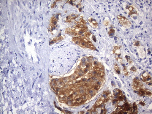 AMACR / P504S Antibody - Immunohistochemical staining of paraffin-embedded carcinoma of human prostate tissue using anti-AMACR mouse monoclonal antibody. HIER pretreatment was done with 1mM EDTA in 10mM Tris buffer. (pH8.0) at 120°C for 2.5 minutes.was diluted 1:800 and detection was done with HRP secondary and DAB chromogen. Strong cytoplasmic and membraneous stain was seen in tumor cells.