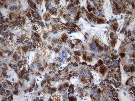 AMACR / P504S Antibody - Immunohistochemical staining of paraffin-embedded carcinoma of human liver tissue using anti-AMACR mouse monoclonal antibody. HIER pretreatment was done with 1mM EDTA in 10mM Tris buffer. (pH8.0) at 120°C for 2.5 minutes.was diluted 1:800 and detection was done with HRP secondary and DAB chromogen. Strong cytoplasmic and membraneous stain was seen in tumor cells.